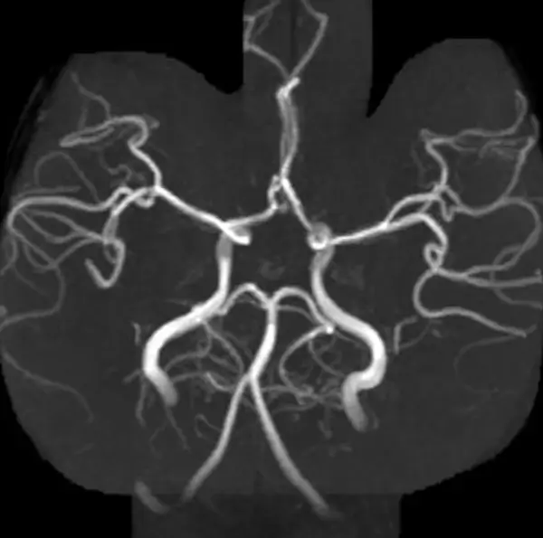 MR Angiography Intracranial Vessels